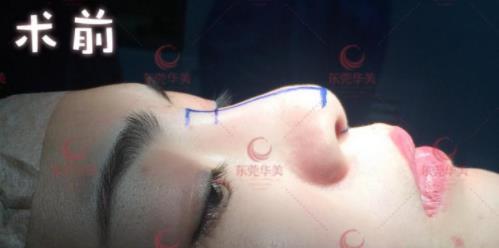 東莞華美醫(yī)療美容:首發(fā)ATR自體美雕鼻技術(shù),“0”距離專家面診
