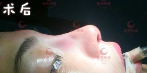 東莞華美醫(yī)療美容:首發(fā)ATR自體美雕鼻技術(shù),“0”距離專家面診