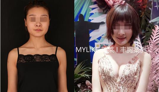 鄭州美萊整形口碑如何 精湛的技術(shù)專業(yè)的態(tài)度讓你滿意