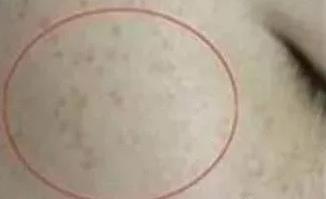 北京伊美爾幸福醫(yī)院:光子嫩膚能維持多久