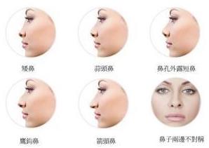南京韓辰整形醫(yī)院院長揭秘鼻部綜合整形與假體隆鼻的區(qū)別
