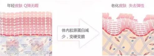 為什么要做線雕提拉?廈門薇格整形醫(yī)院告訴你