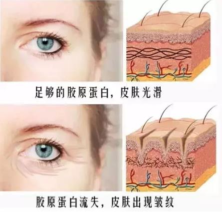 為什么要做線雕提拉?廈門薇格整形醫(yī)院告訴你