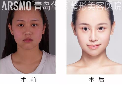 青島華韓整形美容醫(yī)院趙煜楠靠譜嗎 擅長什么手術(shù) 哪些案例