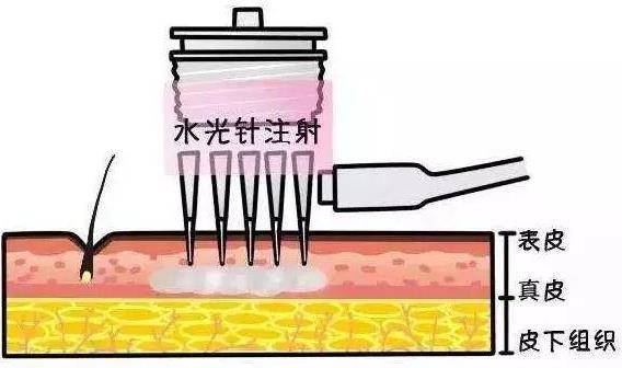 北京伊美爾紫竹醫(yī)院:注射水光針多少錢