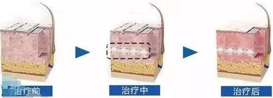 北京伊美爾紫竹醫(yī)院:注射水光針多少錢