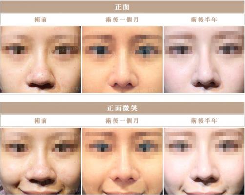 臺灣雅豐醫(yī)美產(chǎn)后隆鼻火熱 整型隆鼻回歸更添自信
