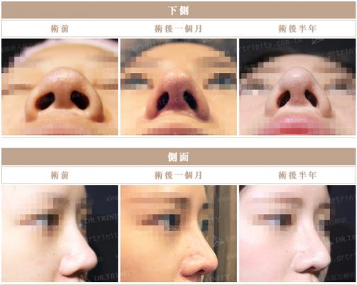 臺灣雅豐醫(yī)美產(chǎn)后隆鼻火熱 整型隆鼻回歸更添自信
