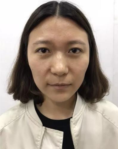 廈門薇格整形醫(yī)院:玻尿酸讓她從“干癟火柴妹”變成“精致小姐姐”