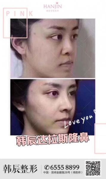 昆明韓辰假體隆鼻怎么樣 材料達標 手術安全放心