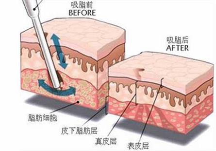藝美整形王東院長 脂肪填充怎么樣 量身定制打造完美額頭