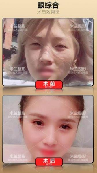 福州米蘭整形眼綜合怎么樣 給你的不只是自信