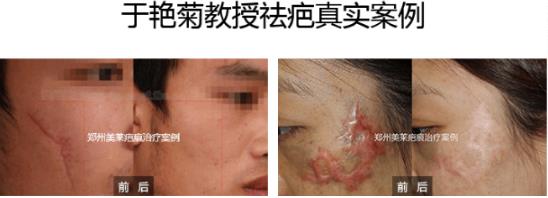 鄭州美萊整形靠不靠譜 科學(xué)祛疤祛胎記 效果見證實力