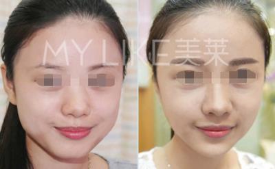 鄭州美萊整形靠譜么 口碑致勝 專業(yè)技術(shù)為你塑造美麗