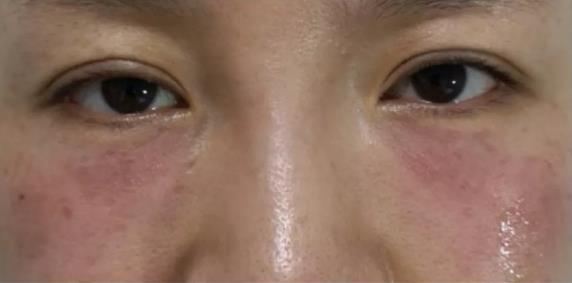 廈門薇格醫(yī)院做眼部整形專業(yè)嗎 讓您更美一點