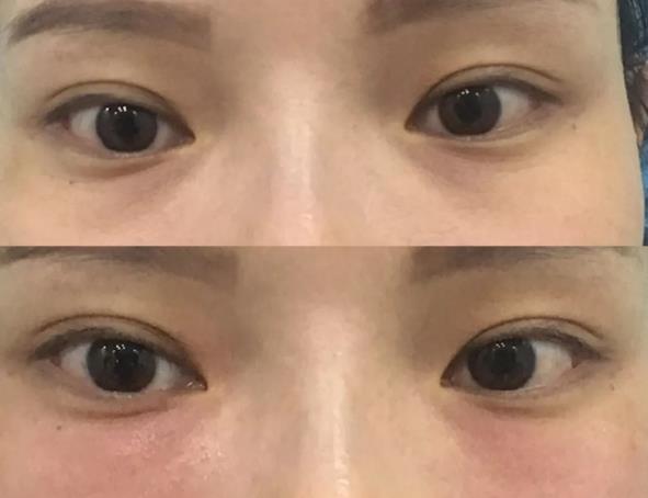 廈門薇格醫(yī)院做眼部整形專業(yè)嗎 讓您更美一點
