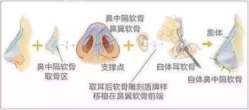 北京伊美爾健翔醫(yī)院:隆鼻的害處