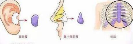 北京伊美爾健翔醫(yī)院:隆鼻的害處