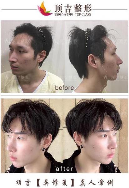 武漢頂吉鼻修復(fù)效果怎么樣 純韓專家重塑自然美鼻