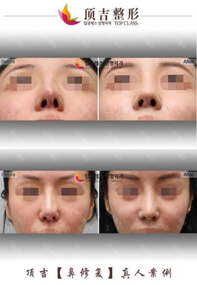 武漢頂吉鼻修復(fù)效果怎么樣 純韓專家重塑自然美鼻