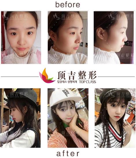 武漢頂吉鼻整形如何 頂吉名品鼻無懼揉捏 自然天成