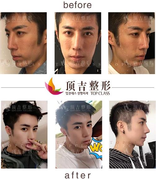 武漢頂吉鼻整形如何 頂吉名品鼻無懼揉捏 自然天成