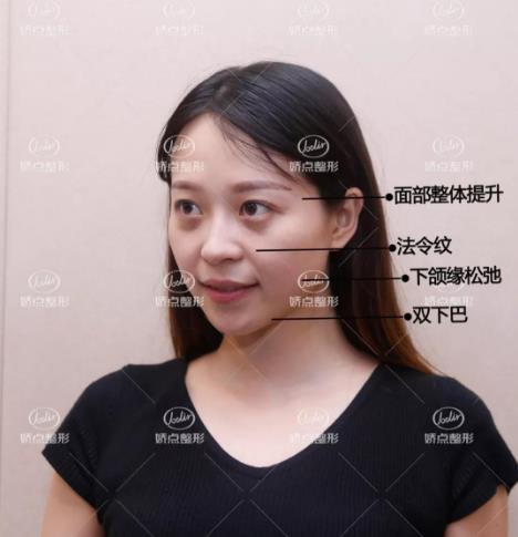 成都嬌點(diǎn)整形胡浪熱提拉:不被年齡限制 活出自己想要的精彩