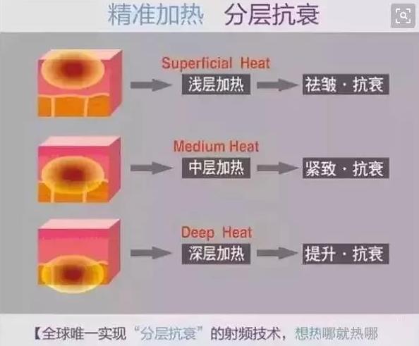 成都嬌點(diǎn)整形胡浪熱提拉:不被年齡限制 活出自己想要的精彩