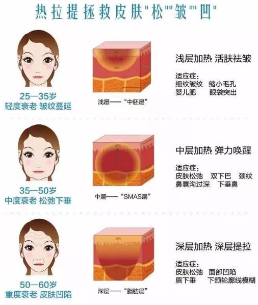 成都嬌點(diǎn)整形胡浪熱提拉:不被年齡限制 活出自己想要的精彩