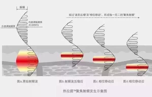 成都嬌點(diǎn)整形胡浪熱提拉:不被年齡限制 活出自己想要的精彩