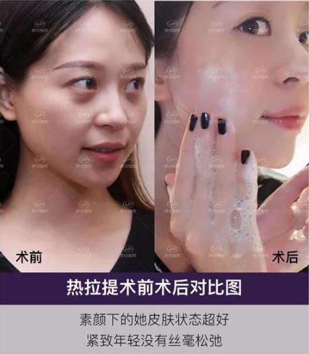 成都嬌點(diǎn)整形胡浪熱提拉:不被年齡限制 活出自己想要的精彩