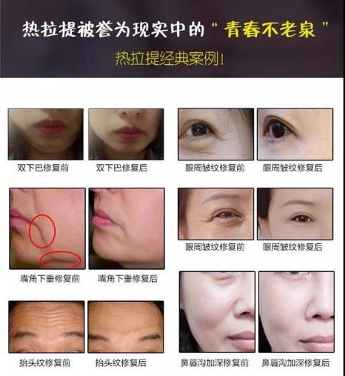 成都嬌點(diǎn)整形胡浪熱提拉:不被年齡限制 活出自己想要的精彩