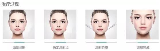 北京伊美爾醫(yī)療醫(yī)院:肉毒素多少錢