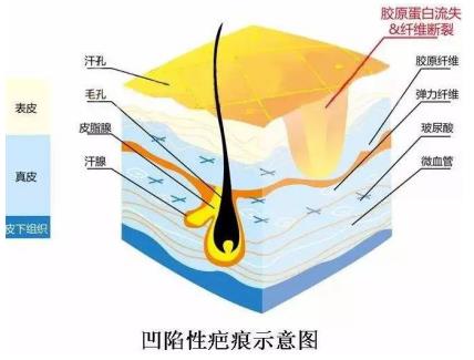 北京伊美爾醫(yī)療醫(yī)院:去疤痕多少錢