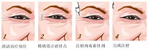 北京伊美爾醫(yī)療醫(yī)院:肉毒素多少錢