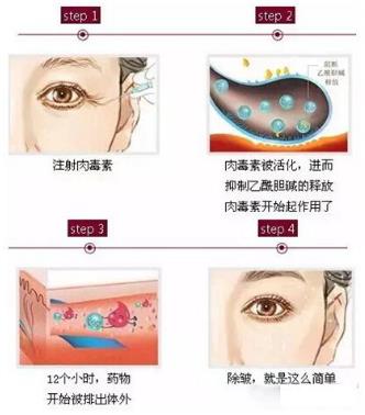 北京伊美爾醫(yī)療醫(yī)院:肉毒素多少錢