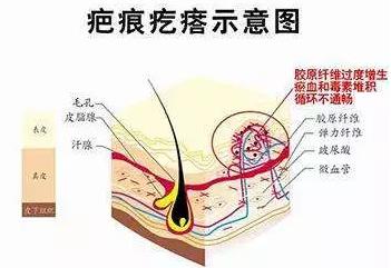 北京伊美爾醫(yī)療醫(yī)院:去疤痕多少錢