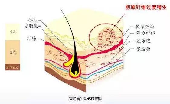 北京伊美爾醫(yī)療醫(yī)院:去疤痕多少錢