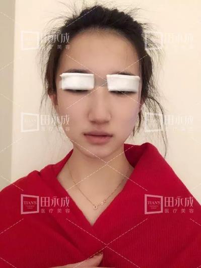銀川田永成整形做雙眼皮好不好 美是需要“整”理的微整形