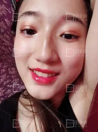 銀川田永成整形做雙眼皮好不好 美是需要“整”理的微整形