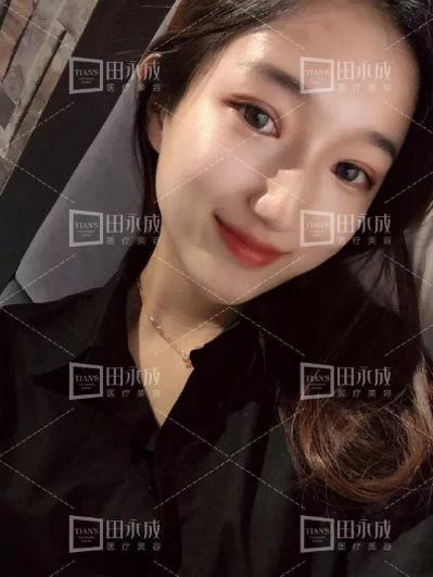 銀川田永成整形做雙眼皮好不好 美是需要“整”理的微整形