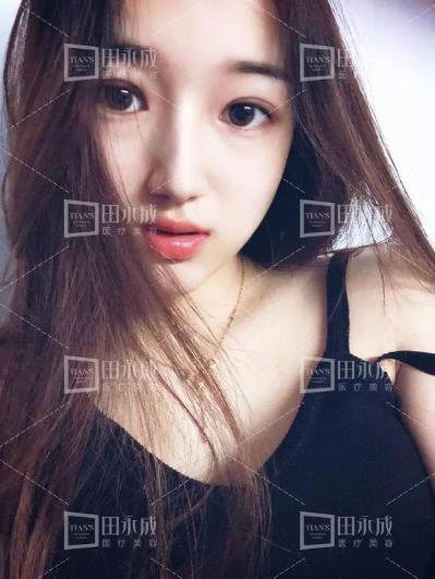 銀川田永成整形做雙眼皮好不好 美是需要“整”理的微整形