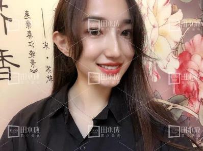 銀川田永成整形做雙眼皮好不好 美是需要“整”理的微整形