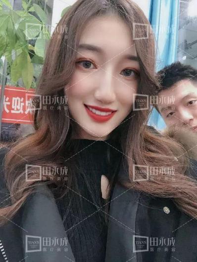 銀川田永成整形做雙眼皮好不好 美是需要“整”理的微整形