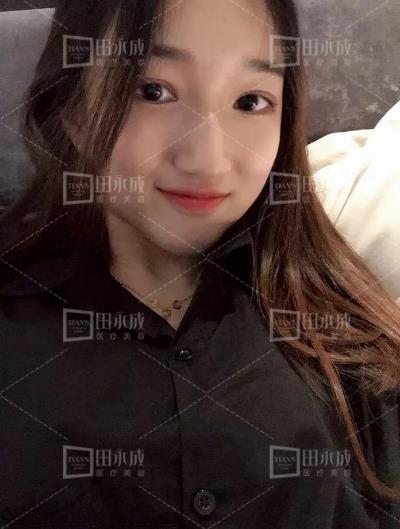 銀川田永成整形做雙眼皮好不好 美是需要“整”理的微整形
