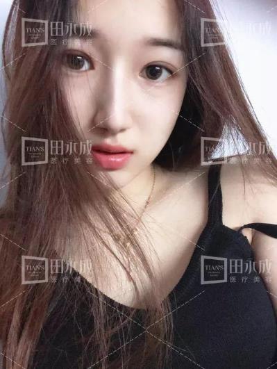 銀川田永成整形做雙眼皮好不好 美是需要“整”理的微整形