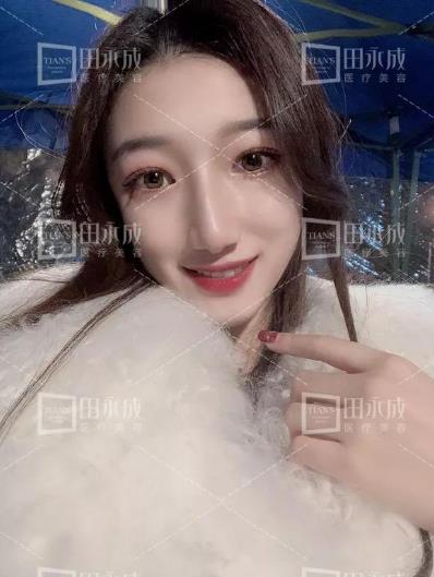 銀川田永成整形做雙眼皮好不好 美是需要“整”理的微整形