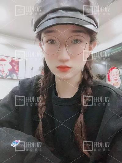 銀川田永成整形做雙眼皮好不好 美是需要“整”理的微整形
