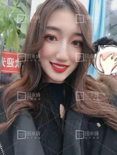 銀川田永成整形做雙眼皮好不好 美是需要“整”理的微整形
