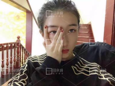 銀川田永成整形做雙眼皮好不好 美是需要“整”理的微整形